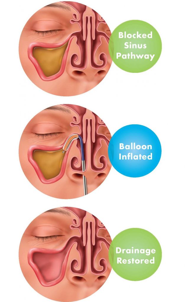 InOffice Balloon Sinuplasty Treatment Syracuse Sinus Center